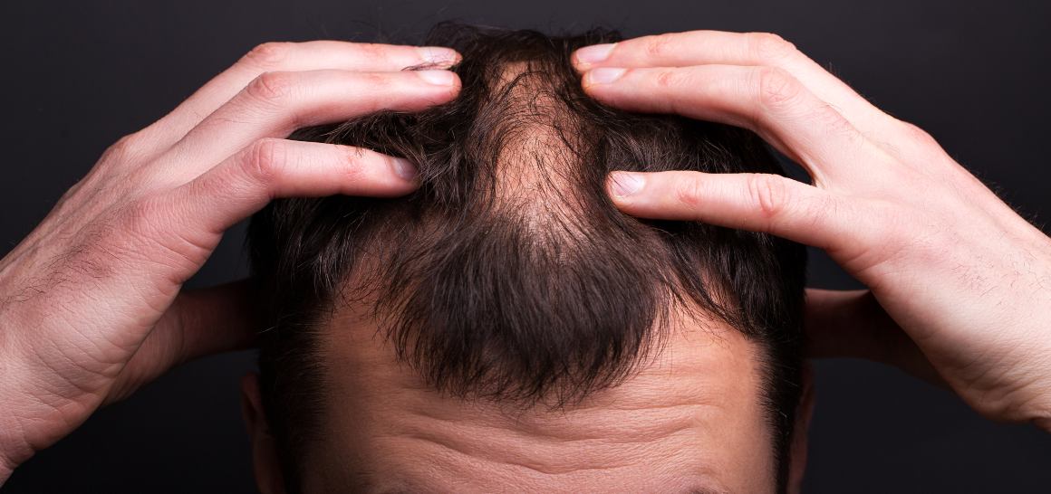 Czy olej CBD może pomóc w poroście włosów?